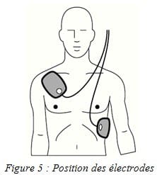 position electrodes defibrillateur